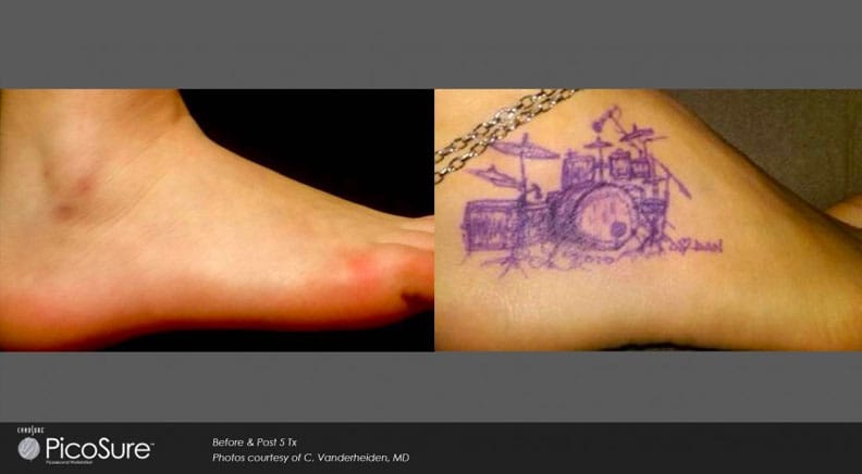 Vorher/Nachher Beispiel einer Tattoo-Entfernung nach 5 Behandlungen